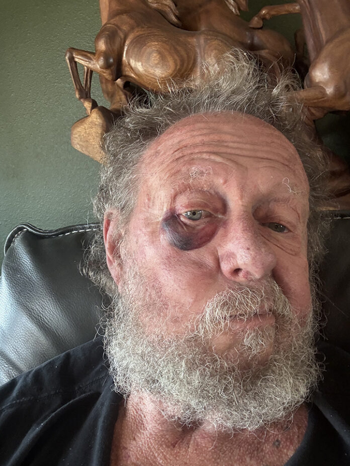 Ya oughta see the other guy!